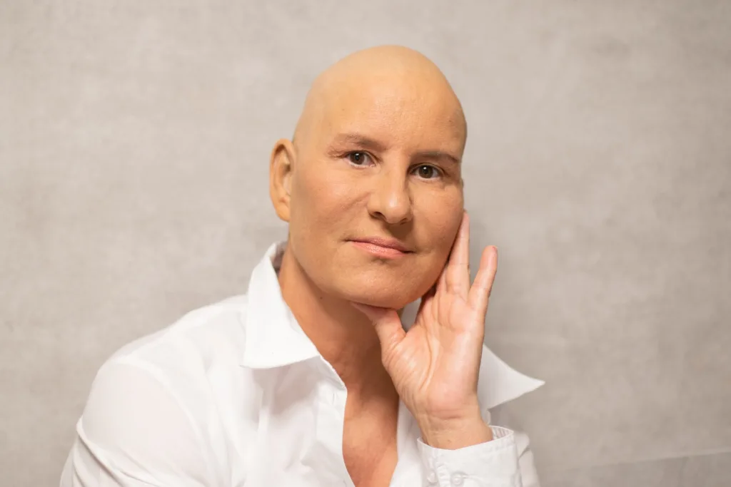 hombre sin pelo por Cancer